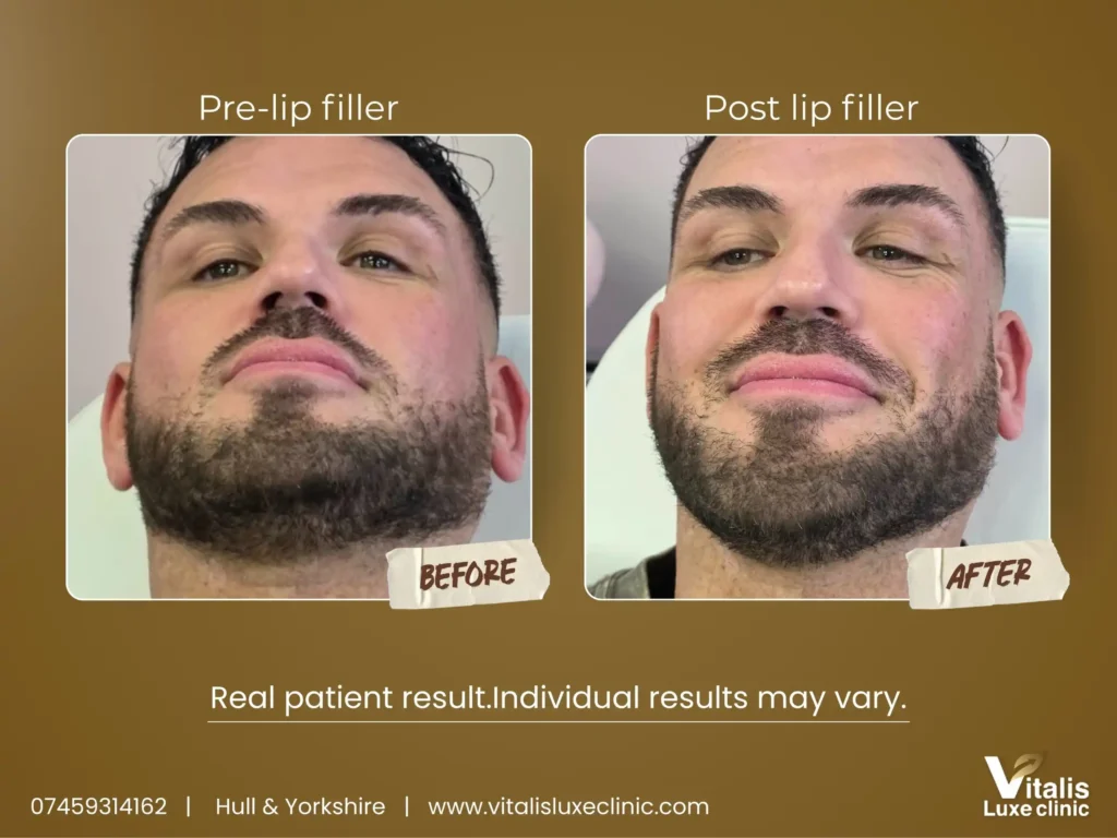 Lip Filler Before and after