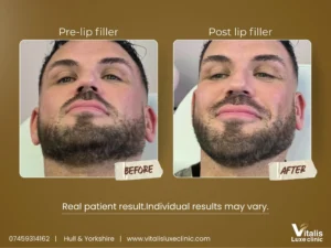 Lip Filler Before and after