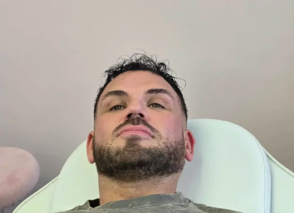 Lip Fillers Before Treatment 1 edited