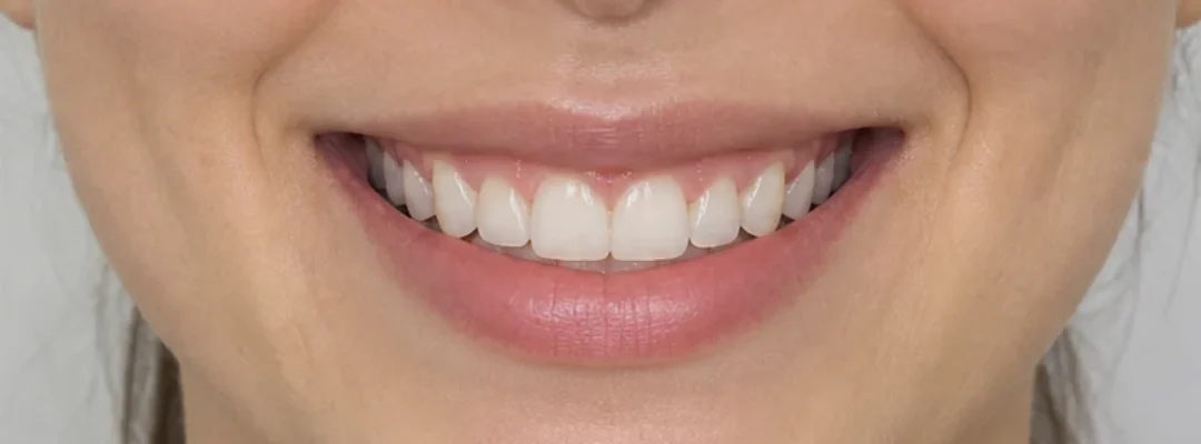After Gummy Smile Botox