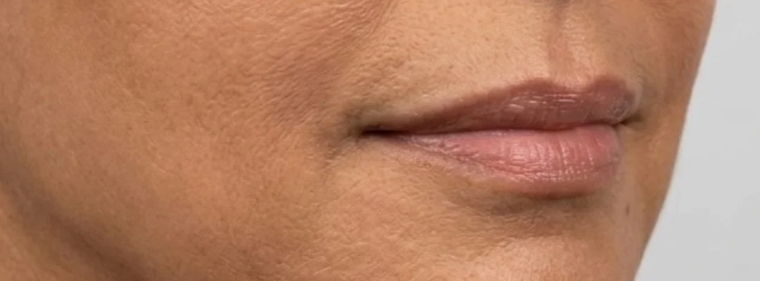 After Marionette Lines Filler