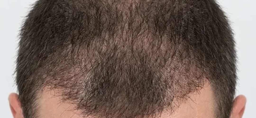 After Microneedling Hair Treatment