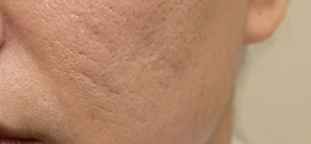 After Microneedling Scar Treatment