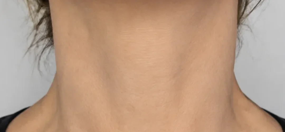 After Neck Botox