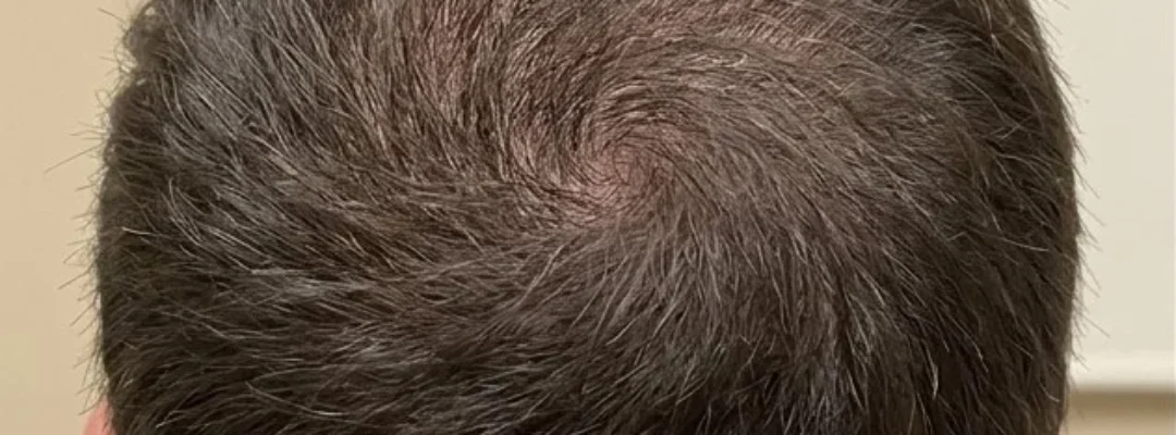 After PRP Hair Treatment
