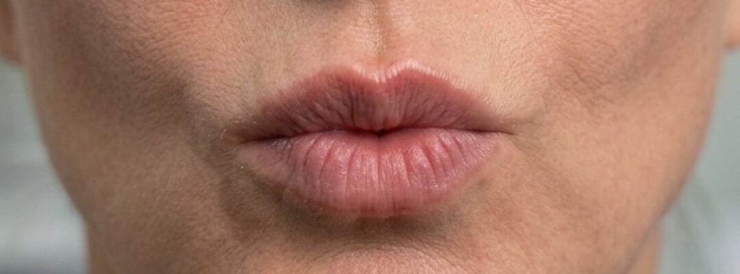 After Smoker Lines Botox