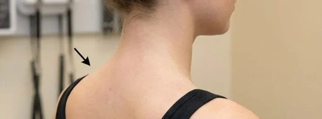 After Trap Botox