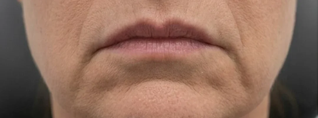 Before DAO Botox