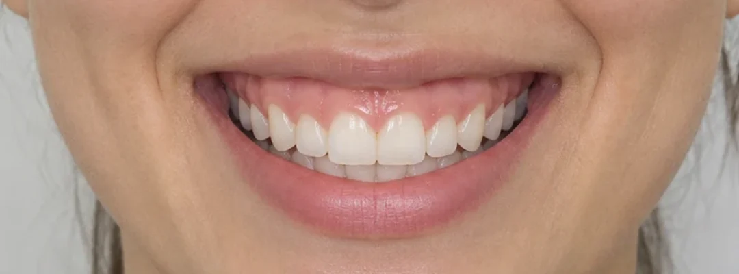 Before Gummy Smile Botox