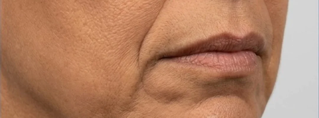 Before Marionette Lines Filler