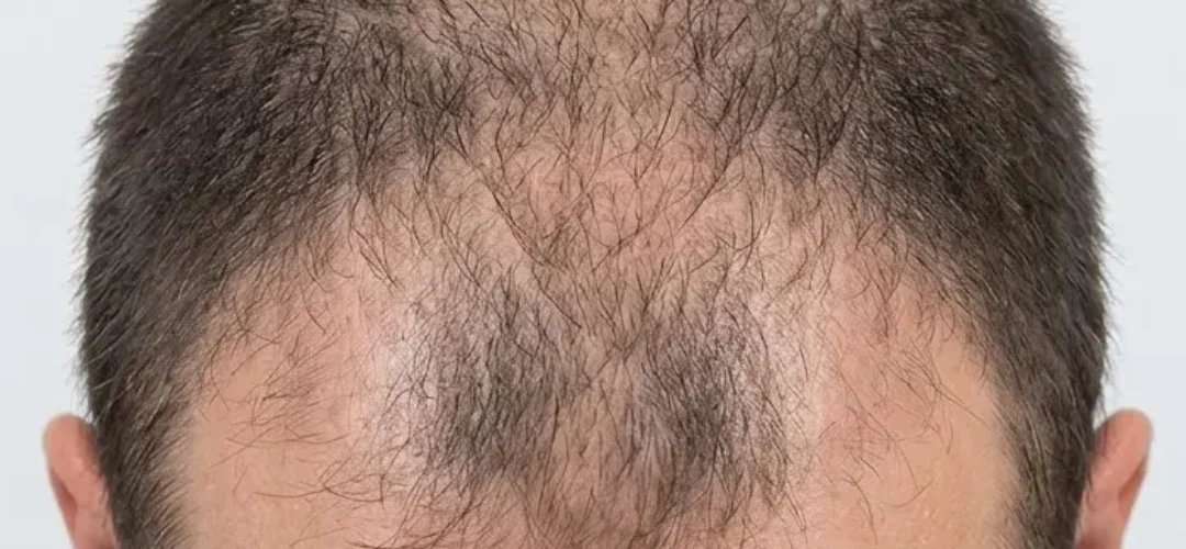 Before Microneedling Hair Treatment