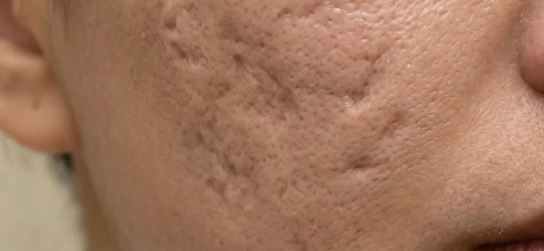 Before Microneedling Scar Treatment