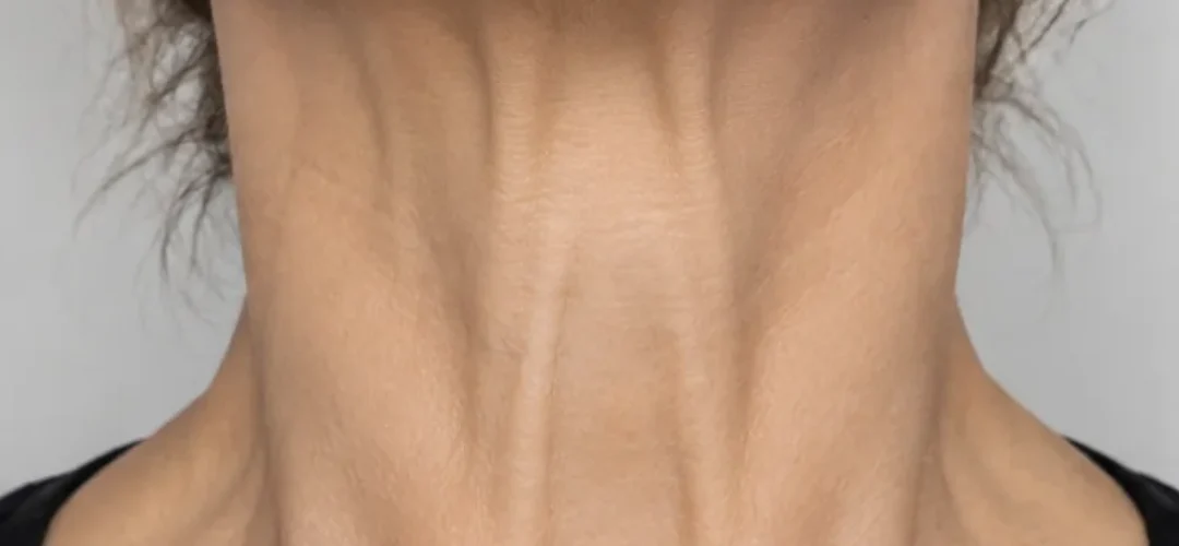 Before Neck Botox