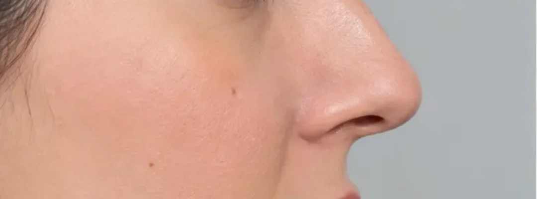 Before Noise Filler Treatment
