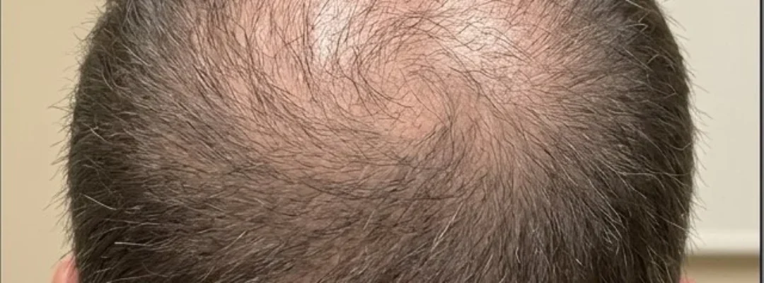 Before PRP Hair Treatment