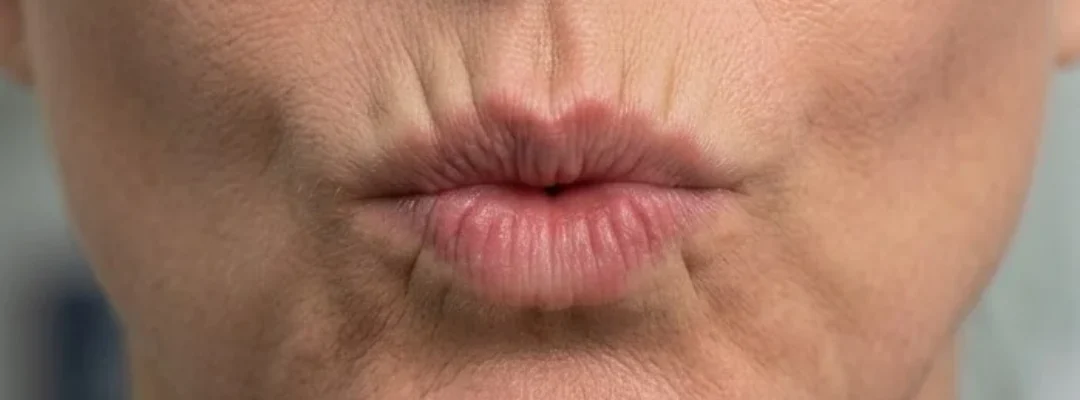 Before Smoker Lines Botox