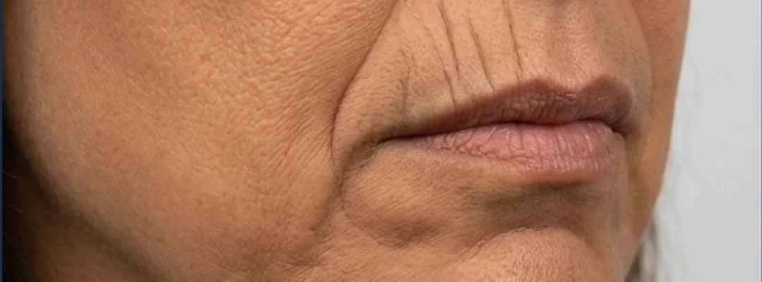 Before Smoker’s Lines Filler
