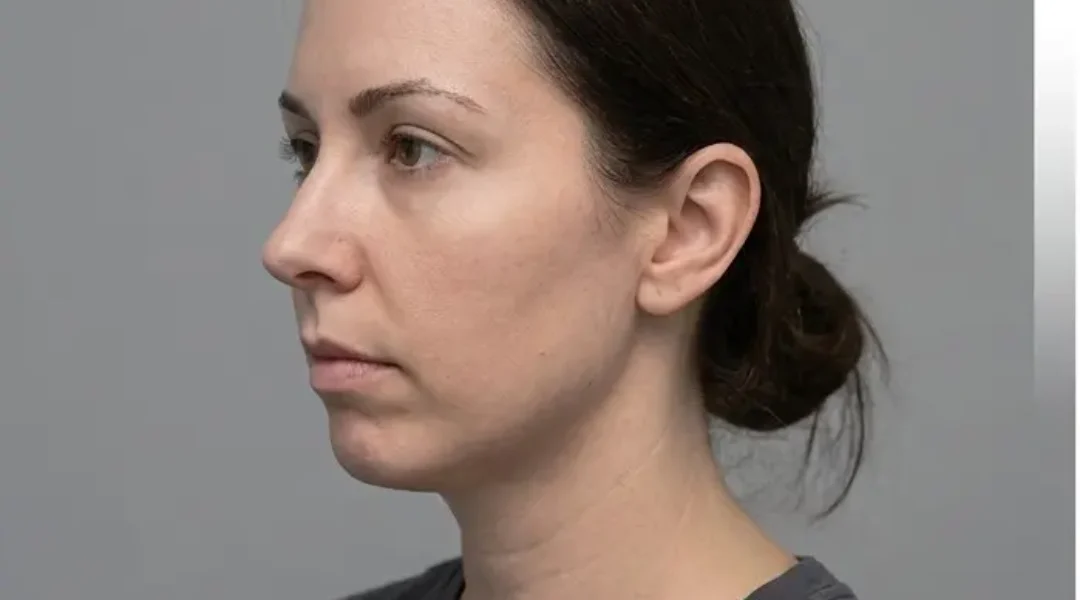 Chin Filler Before treatment