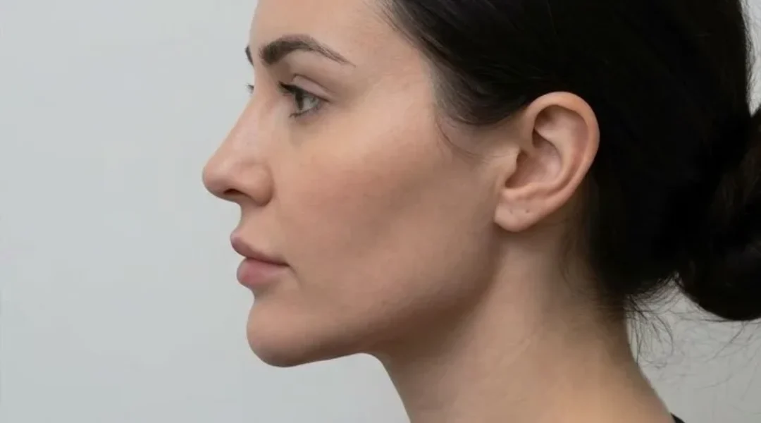 Jawline Filler after treatment