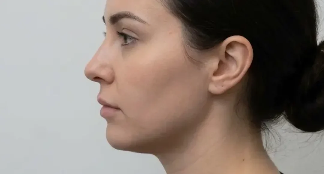 Jawline Filler before treatment