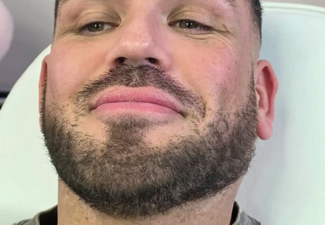 Lip Fillers After Treatment Result