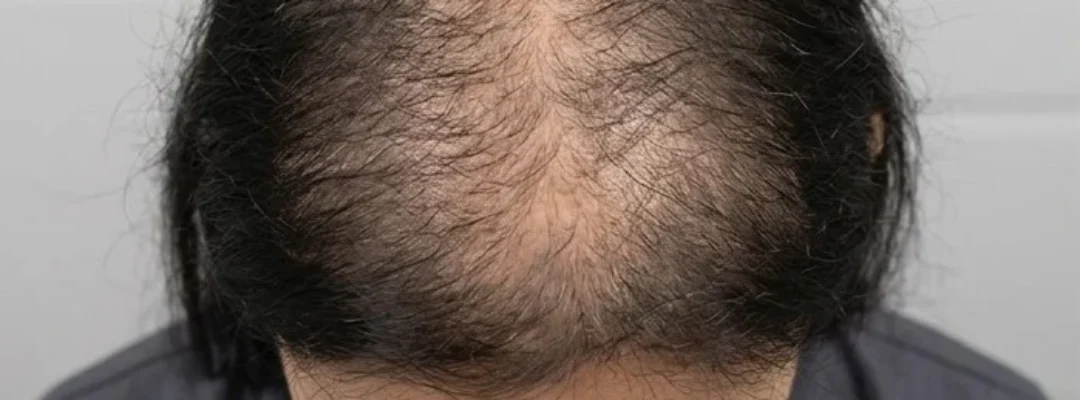 Polynucleotides Hair Before Treatment