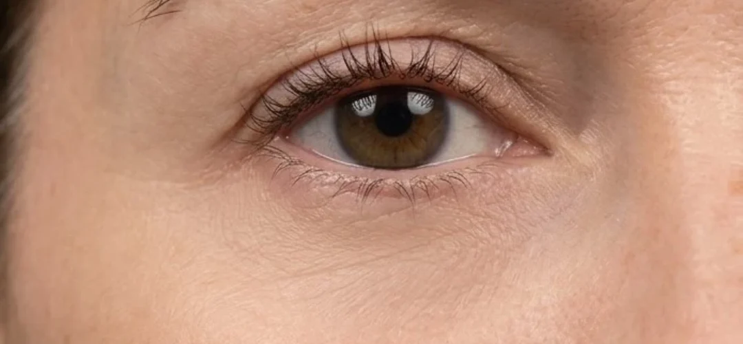Polynucleotides Under Eyes After Treatment