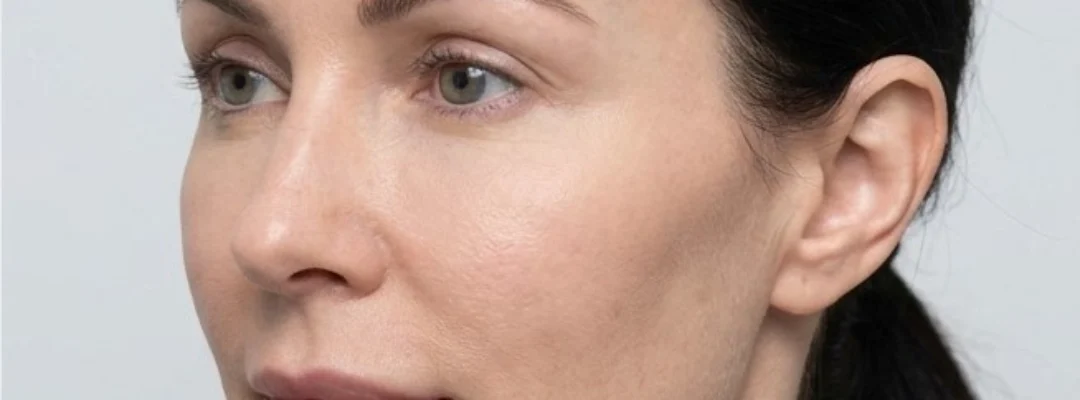 Temple Filler After Treatment
