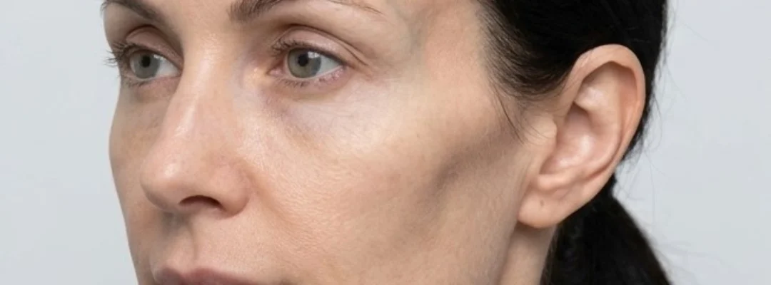 Temple Filler Before Treatment