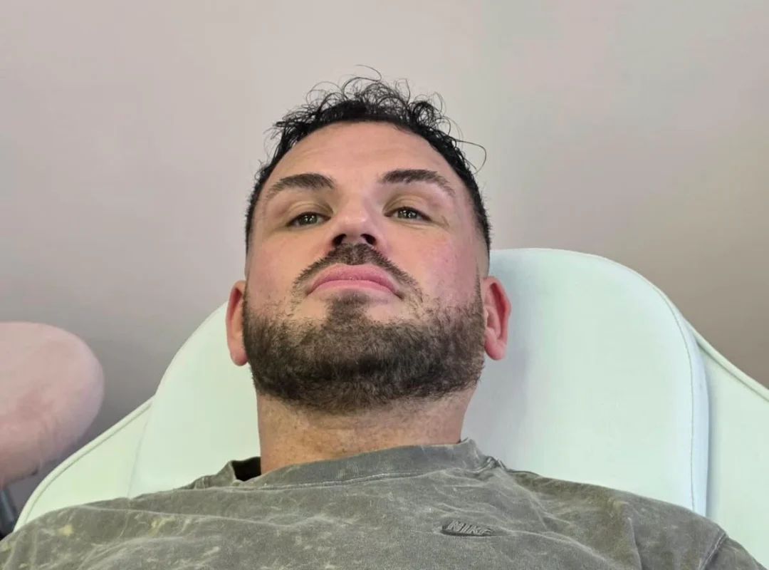 Vitalis - Lip Fillers Before Treatment